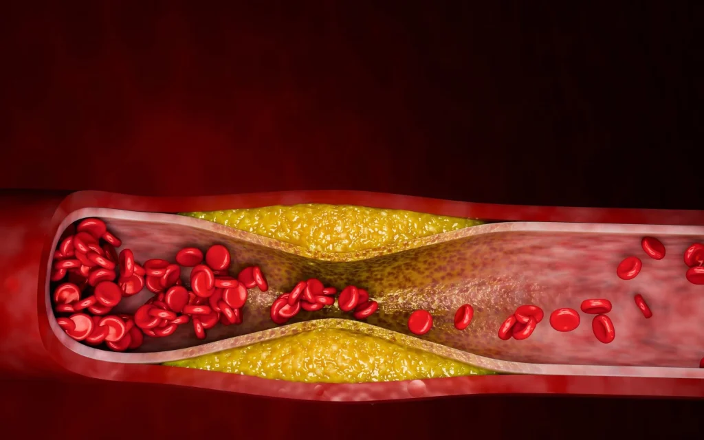 Lipoprotein(a) Blood Test